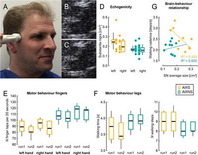 Enlarged Area of Mesencephalic Iron Deposits in Adults Who Stutter